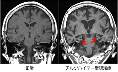 アルツハイマー型認知症