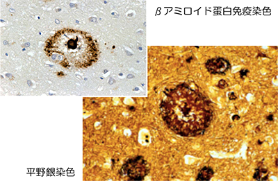 「老人斑」の顕微鏡写真