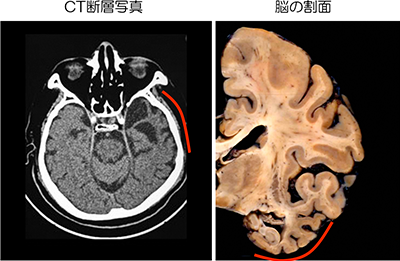 脳萎縮が顕著な部位