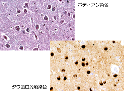 前頭側頭型認知症の一つに分類されるPick病の病理変化